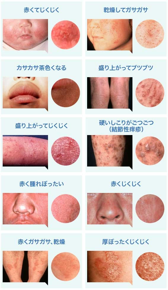 〜アトピー性皮膚炎の湿疹のタイプ〜