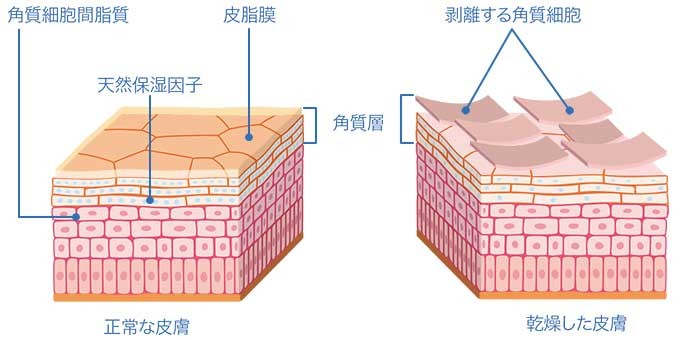 アトピー性皮膚炎の患者さんと普通の健康的な肌の違い