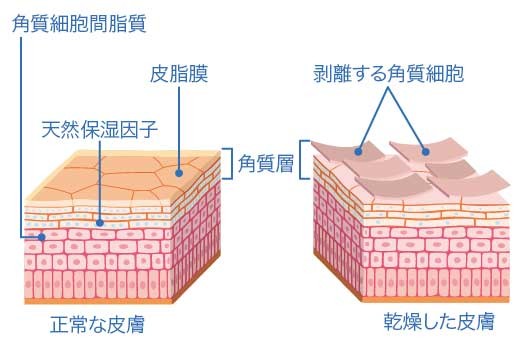 アトピー性皮膚炎の患者さんと普通の健康的な肌の違い